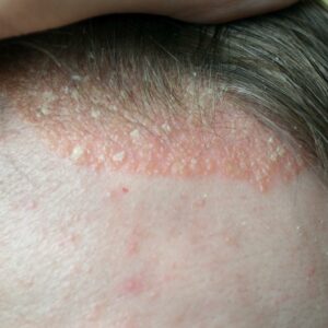 All you need to know about scalp psoriasis