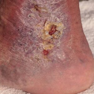 Causes and Symptoms of Cellulitis