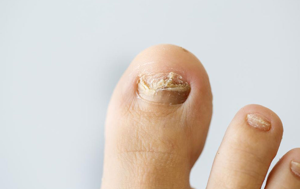 Common nail infections to avoid