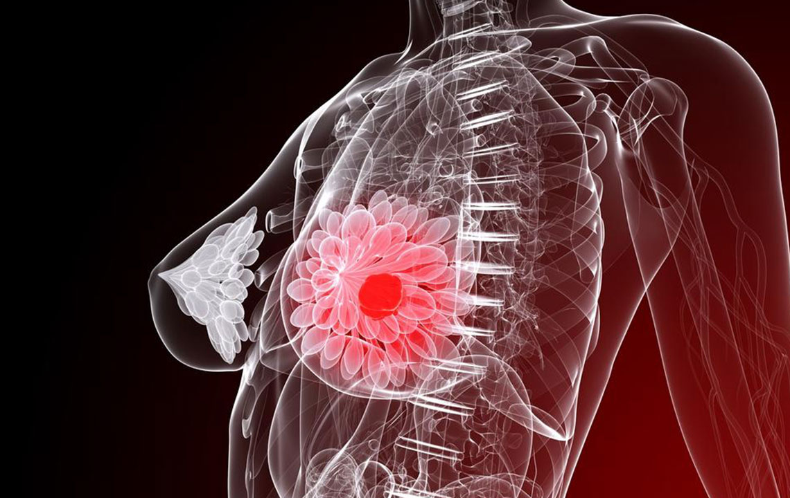 Five things you need to know about breast cancer