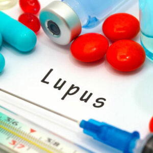 Lupus &#8211; An Overview