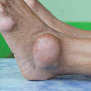 Preventive care for dealing with gout foot pain