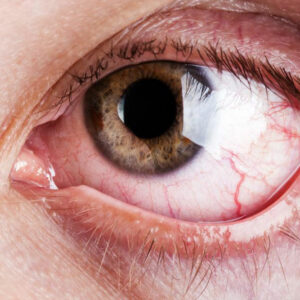 What are the common and rare symptoms of Graves’ disease