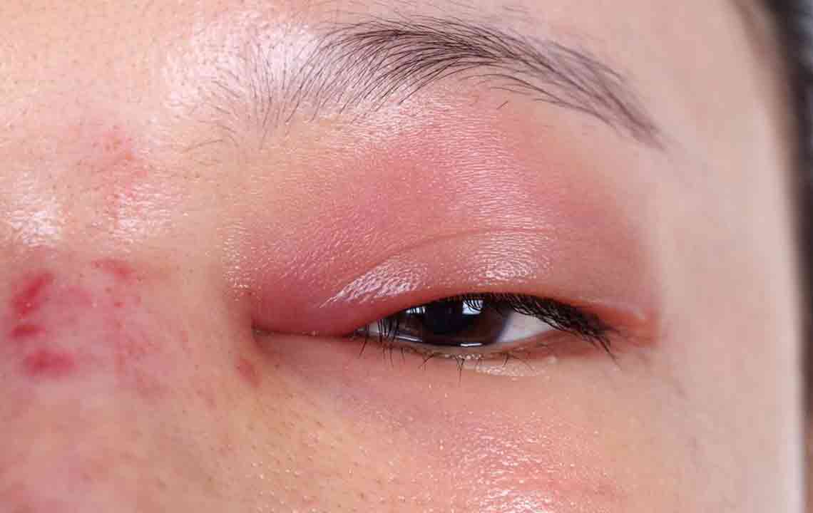 10 ways to fix your under eye puffiness