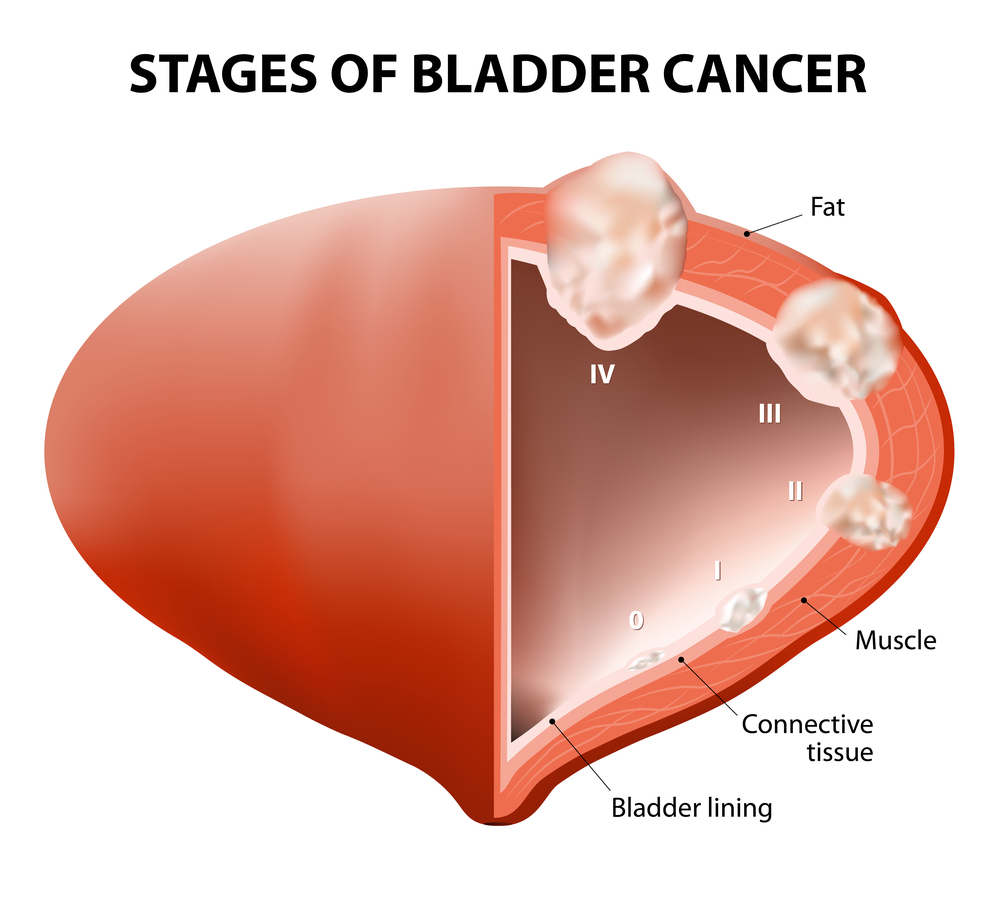 A Guide To Understanding Bladder Cancer