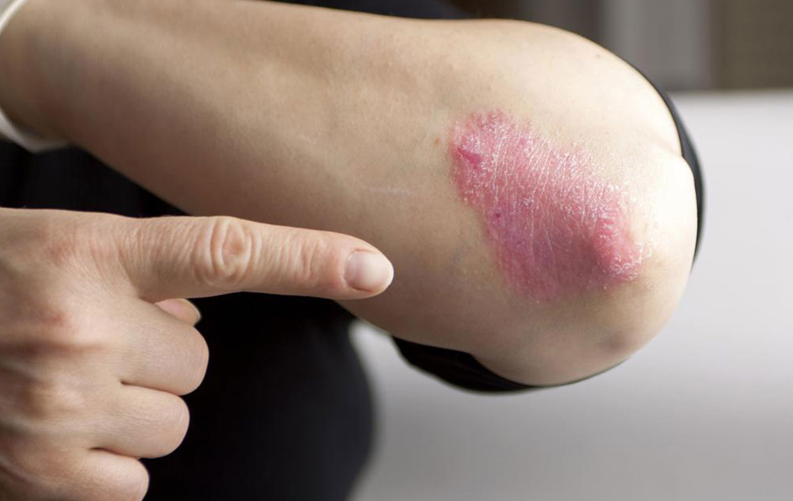 Chronic Plaque Psoriasis And its Effective Treatment