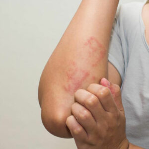 Dietary Changes and Tips to Cure Shingles Rash