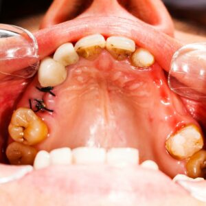 Effective Home Remedies to Treat Cavities