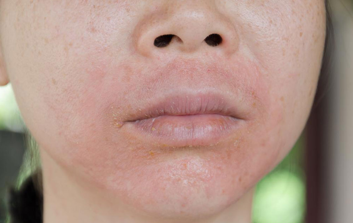 Effective Treatments for Eczema