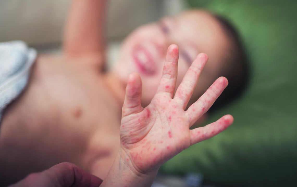 Find the Cure for Baby Eczema with the Right Creams