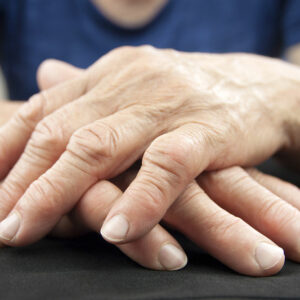 Here is what you must know about rheumatoid arthritis