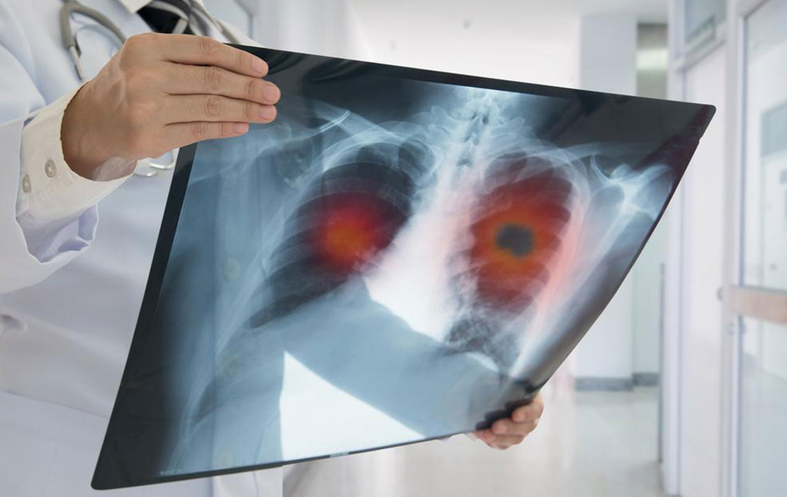 Know the causes, symptoms, and treatment of non-small cell lung cancer