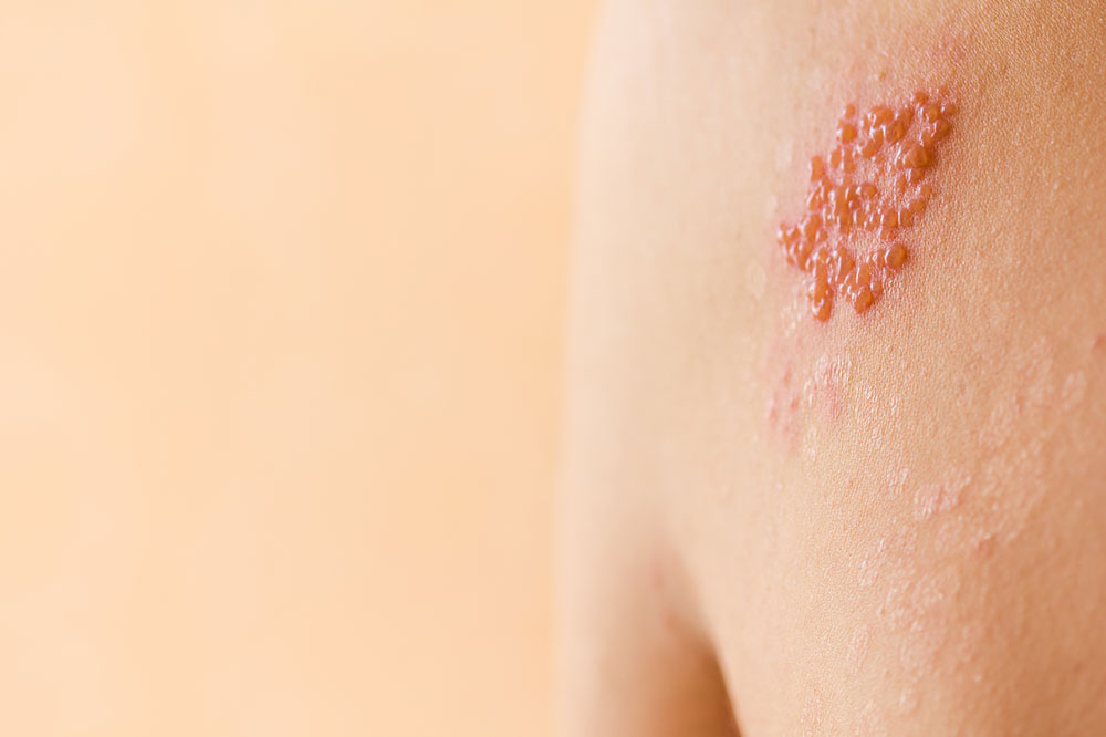 Symptoms and causes of shingles