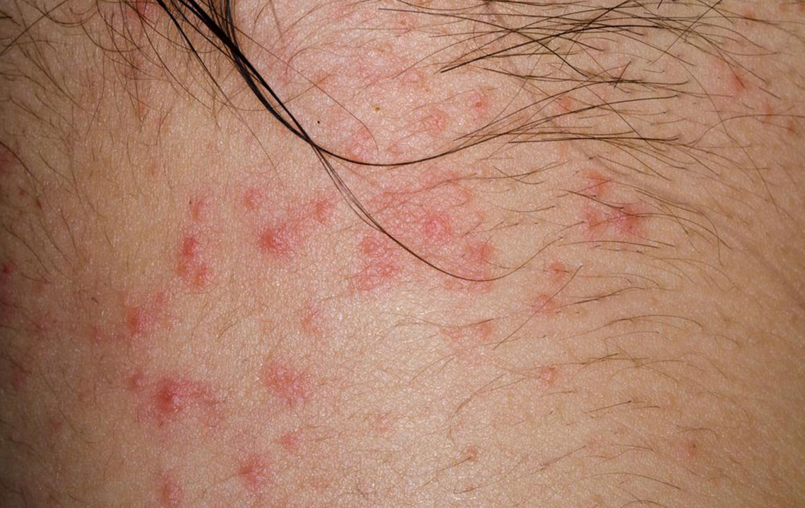 Types of Eczematous Dermatitis and Their Symptoms