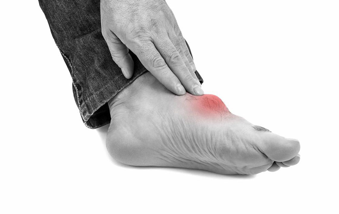 What You Need to Know about Gout