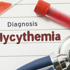 Various Aspects of Polycythemia Vera